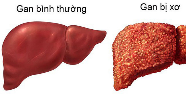 Bệnh xơ gan là gì? Ai dễ bị xơ gan nhất?
